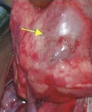 Pulmão com malformação adenomatoide cística (seta num dos cistos) durante uma cirurgia torácica em uma criança.
