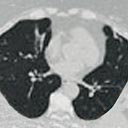 Tomografia do tórax, no lado esquerdo e, acima, uma bronquiectasia (região branca dilatada).