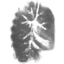 Radiografia do tórax (broncografia) demonstrando as bronquiectasias.