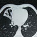 Tomografia do tórax com bronquiectasias (áreas esbranquiçadas do lado esquerdo).