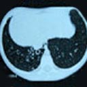 Tomografia do tórax com pequena bronquiectasia circular, localizada à esquerda.
